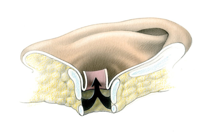 Ear Canal Closure in Skull Base Surgery – Skull Base Surgery Atlas