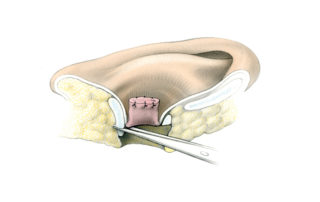 Working from the postauricular side, the canal cartilage is removed or scored to break its spring. This facilitates coaptation of the sub-meatal soft tissues to serve as a second closure layer.