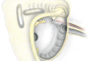 View of the anatomical relations of the facial nerve in the middle ear and mastoid after a canal wall down mastoidectomy with removal of the tympanic membrane and the lateral two ossicles. In the anterior portion of the tympanic segment, the key landmark for the facial nerve is the cochleariform process. This bony knob is the attachment point at which the tensor tympani tendon bends laterally towards its insertion on the malleus. It is positioned immediately inferior to the facial nerve. When it is obscured by disease, the cochleariform can be located by tracing the tympanic plexus up the promontory towards it. Alternatively, locating the eustachian tube orifice leads in turn to the tensor tympani semicanal which can be traced to the cochleariform. The key landmarks to the posterior tympanic segment are the stapes and oval window. Even with extensive disease processes which have destroyed the stapes superstructure, the oval window depression can be identified by dissecting up the posterior tympanum along the promontory and in the sinus tympani. (Lab, labyrinthine segment; GSPN, greater superficial petrosal nerve; GG, first genu and geniculate ganglion; Horiz, horizontal or tympanic segment; Vert, vertical or mastoid segment; P, pyramidal process and stapedius tendon; RW, round window; PSCC, posterior semicircular canal; LSCC, lateral semicircular canal; CP, cochleariform process; TTT, tensor tympani tendon; TTS, tensor tympani semicanal; ET, eustachian tube; TP, tympanic plexus (Jacobson’s and Arnold’s nerves); CT, chorda tympani nerve.)