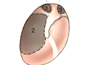 The growth pattern of the cholesteatoma may predict the segment of the facial nerve which is likely to be involved with cholesteatoma. The most common original to cholesteatoma is the posterior epitympanum (1) followed by the posterior mesotympanum (2). The anterior epitympanic route (3) is least common. At times, cholesteatoma arise concurrently via multiple routes.