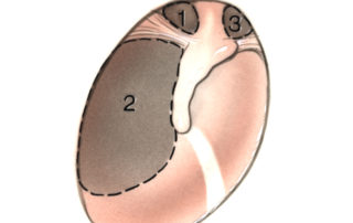 The growth pattern of the cholesteatoma may predict the segment of the facial nerve which is likely to be involved with cholesteatoma. The most common original to cholesteatoma is the posterior epitympanum (1) followed by the posterior mesotympanum (2). The anterior epitympanic route (3) is least common. At times, cholesteatoma arise concurrently via multiple routes.