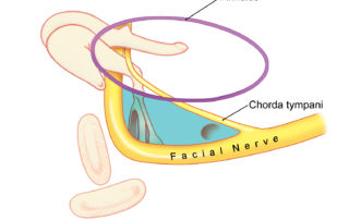 Schematic representation of the relationships of the facial recess and the middle exposure afforded by its opening (blue). (A, annulus; CT, chorda tympani; FN, facial nerve.)