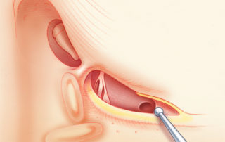 Inferior extension of the facial recess approach, as used in cochlear implantation, to expose the round window.