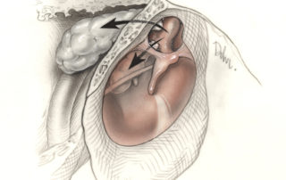 In the posterior epitympanic growth pattern the sac usually lies lateral to the ossicles. This route of cholesteatoma is likely to erode the facial nerve in its intratympanic segment just above the stapes.