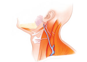 Several nerves are available regionally for use in reconstructing the facial nerve. The greater auricular nerve is the most frequent nerve utilized for interposition grafting of the facial nerve. It is favored due to its proximity to the operative field, excellent size match, and minimal donor deficit. The transverse cervical nerve is another sensory branch suitable for use in facial nerve reconstruction. (GA, greater auricular nerve; TC, transverse cervical nerve.)