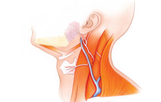 Several nerves are available regionally for use in reconstructing the facial nerve. The greater auricular nerve is the most frequent nerve utilized for interposition grafting of the facial nerve. It is favored due to its proximity to the operative field, excellent size match, and minimal donor deficit. The transverse cervical nerve is another sensory branch suitable for use in facial nerve reconstruction. (GA, greater auricular nerve; TC, transverse cervical nerve.)