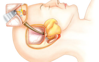 Complete exposure of the intratemporal portion of the facial nerve in a hearing ear requires a combined middle fossa (segment proximal to the geniculate ganglion) and transmastoid (segment distil to the geniculate ganglion) approaches. In a deaf ear, the entire nerve can be exposed via a translabyrithine approach.