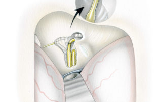 Repair of the facial nerve by re-routing across the base of the geniculate triangle. The repair couples the labyrinthine and upper horizontal segments. It should be noted that while the native nerve can be preserved in many geniculate hemangiomas, schwannomas almost always necessitate resection and grafting.