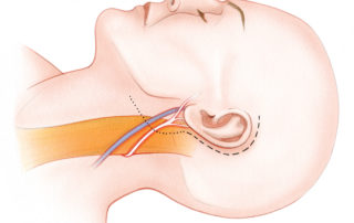 To expose the greater auricular nerve, a postauricular incision is carried inferiorly into the upper neck. The incision can usually be placed in a natural skin crease and thus creating only a subtle scar.