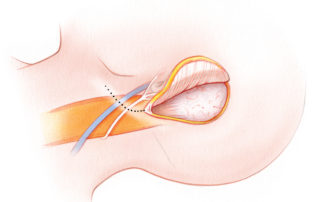 After completing the intratemporal portion of the procedure, the incision is extended into the upper neck.