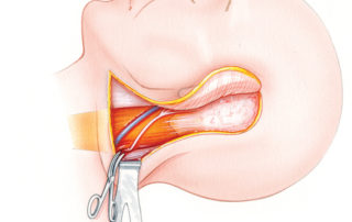 The greater auricular nerve parallels the external jugular vein and courses somewhat superior to it across the surface of the sternomastoid muscle. To obtain a long segment of the nerve, it can be taken form its branch point under the pinna back to its exit from the spine.