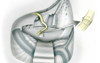 With relatively short defects in the facial nerve following a translabyrinthine resection of an acoustic neuroma, repair can be affected by mobilizing the redundant nerve in the temporal bone and performing primary anastomosis. This so-called mastoid-meatal re-routing has the advantage of achieving repair with a single anastomosis.