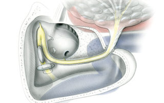 The facial nerve seen in its normal anatomic position within the temporal bone seen after completion of a canal wall down mastoidectomy (subtotal petrosectomy). Note than the descending portion of the nerve in the mastoid overlies the jugular foramen. (1G, first genu; 2G, second genu; SMF, stylomastoid foramen; JB, jugular bulb; CA, carotid artery.)