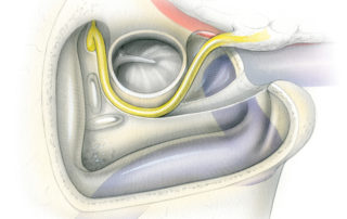 Anterior re-routing of the facial nerve with the ear canal in place gains relatively little additional exposure of the jugular foramen region.