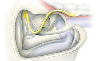 With the ear canal removed the facial nerve can be displaced forward with the hinge point either at the first or second genu (as depicted here).