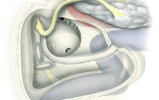Full mobilization of the facial nerve from the first genu to the stylomastoid foramen substantially enhances surgical exposure of the jugular foramen and carotid genu. Leaving intact the fascial envelope at the stylomastoid foramen helps to preserve the blood supply to the nerve. Anteriorly re-routing of the nerve can usually be accomplished with either no functional deficit or with transient weakness which recovers well over time. (For use of this technique, see Chapter 8.)