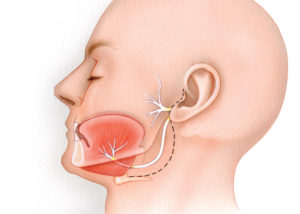 Hypoglossal - facial anastomosis is performed through a pre-auricular incision which is carried into the upper neck approximately 2 cm beneath the mandible (dashed line). (7, facial nerve; 12, hypoglossal nerve; HB, hyoid bone.)