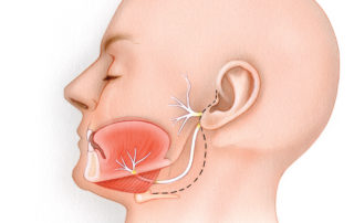 Hypoglossal - facial anastomosis is performed through a pre-auricular incision which is carried into the upper neck approximately 2 cm beneath the mandible (dashed line). (7, facial nerve; 12, hypoglossal nerve; HB, hyoid bone.)