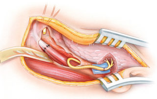 The nerves are then anastomosed over a microsurgical background consisting of a colored piece of plastic sheet. Prior to anastomosis, the cut ends of the nerves are examined microscopically and freshened with sharp microscissors as required. Approximately six interrupted epineurial sutures are used.