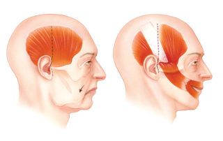 In long standing facial paralysis which is not suitable for a reinnervation procedure, a strip of temporalis muscle can be used to elevate the corner of the mouth. This so-called dynamic sling permits some degree of volitional elevation of the corner of the mouth. Two incisions (dashed lines) are required: preauricular-temporal and oral commissure. The muscle strip is tunneled under the cheek and then split before attachment to the musculofascial plane of the upper and lower lips. Over correction is wise, as some loosing inevitably occurs in the early postoperative period. A cosmetic donor deformity results from the decrease in temporal bulk coupled with a bulge over the zygomatic arch due to the folded muscle pedicle. This hollowed temple appearance can be compensated for by placement of a prosthetic disc (e.g., silastic) in the temporal fossa.
