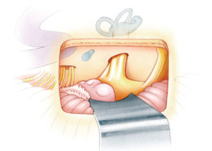 Selective vestibular neurectomy may be performed either proximally, near the brainstem root entry zone, or distally in the internal auditory canal. Neurectomy in the posterior fossa may be performed through either a retrosigmoid exposure (as depicted here) or via the retrolabyrinthine approach (see section 2.3 in Chapter 2). Neurectomy in the internal auditory canal may be accomplished through a middle fossa exposure or, when hearing is absent, via a translabyrinthine approach (see section 2.1 in Chapter 2).