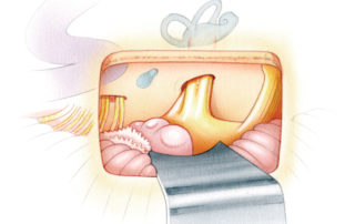 Selective vestibular neurectomy may be performed either proximally, near the brainstem root entry zone, or distally in the internal auditory canal. Neurectomy in the posterior fossa may be performed through either a retrosigmoid exposure (as depicted here) or via the retrolabyrinthine approach (see section 2.3 in Chapter 2). Neurectomy in the internal auditory canal may be accomplished through a middle fossa exposure or, when hearing is absent, via a translabyrinthine approach (see section 2.1 in Chapter 2).