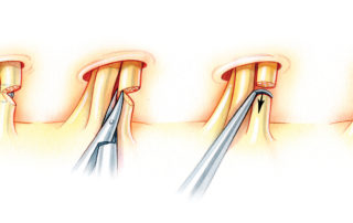 (E) After partial nerve division, the remaining fibers are microdissected from the auditory nerve. (F) The residual vestibular fibers are then divided either with a hook or with scissors. After neurotomy has been accomplished, the nerve ends tend to spring apart a millimeter or two. (G) To discourage healing of the nerve across the gap, the ends should be dissected apart. (H) To further discourage spontaneous nerve repair, removal of a segment of the divided nerve (neurectomy) can be performed.