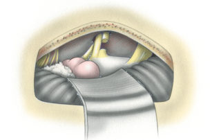 Overview of a completed retrosigmoid vestibular neurectomy. (8, proximal audiovestibular nerve; C, cochlear nerve; V, vestibular nerve; 5, trigeminal nerve; Fl, flocculus; Ch, choroid plexus.)