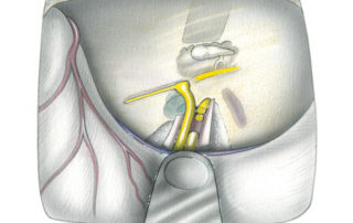 Selective vestibular neurectomy performed via the middle fossa approach involves resection of a segment of both the superior and inferior vestibular nerves. From a functional point of view, the middle fossa neurectomy in the internal auditory canal is superior to the retrosigmoid approach. Section of the nerve laterally, where the auditory and vestibular fiber are well separated, allows a more complete neurectomy. In addition, the vestibular (Scarpa’s) ganglion can be removed in the neurectomy specimen. The disadvantage of the middle fossa approach is the vulnerability of the internal auditory artery, the blood supply to the inner ear, which lies in proximity to the inferior vestibular nerve in the distal internal auditory canal. In addition to a higher incidence of hearing loss, transient facial weakness is also more frequent in the middle fossa approach because of the need to reach under this nerve while dividing the inferior vestibular branch. For these reasons, most neurotologic surgeons divide the nerve proximally, in the posterior fossa, even though the thoroughness of the vestibular neurectomy is somewhat less complete in this location. (SV, superior vestibular nerve; IV, inferior vestibular nerve; 7, facial nerve.)