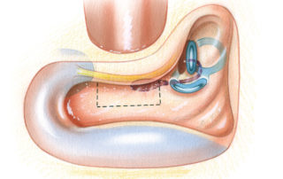 In preparation for exposure of the endolymphatic sac, an intact canal-wall mastoidectomy is performed. In contrast to many drawings that appear in otologic texts, the sac does not reside on the posterior fossa dura superficially in the mastoid. Instead, it is positioned rather medially and sits inferior to the labyrinth. Surgical exposure of the sac is performed through a roughly rectangular window (dashed line) which, when pneumatized, is known as the retrofacial air cell tract. This is bounded anteriorly by the mastoid segment of the facial nerve, posteriorly by the posterior fossa dura, superiorly by the posterior semicircular canal, and inferiorly by the jugular bulb. (LSCC, lateral semicircular canal; SSCC, superior semicircular canal; PSCC, posterior semicircular canal; ES, endolymphatic sac; PFD, posterior fossa dura; JB, jugular bulb; 7, facial nerve.)