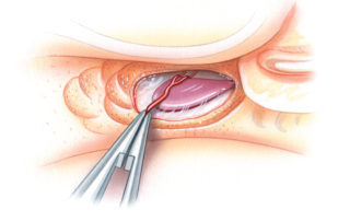 The goal of sac decompression is not merely to identify its edge, but rather to remove bone completely from its lateral surface along with 1 to 2 mm of surrounding dura. Care must be taken to avoid injury to the endolymphatic aqueduct where it penetrates the otic capsule superiorly. Although the entire sac is accessible in the great majority of cases, in a few percent it may lie either predominantly or even completely under the posterior semicircular canal. A small vessel typically traverses the apex of the sac. It is often injured during bone removal and must be controlled with either bipolar cautery or a Gelfoam pledget.