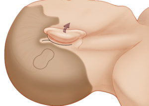 The placement of the cochlear implant receiver/ stimulator (dotted line) should be planned to allow sufficient room between the pinna and the headpiece to enable the comfortable use of a behind-the-ear processor. Approximately 3 to 4 cm should be left between the ear canal and the anterior edge of the device. The device is angled up at about a 45-degree angle superior to the linea temporalis A modified post-auricular incision is used most commonly. Instead of continuing superior to the pinna, the incision can extend into the supra-auricular hairline to facilitate later drilling of the bony well for the receiver/ stimulator case. The length of this extension depends on surgeon preference and the benefit that additional exposure provides when securing the receiver/ stimulator to bone. Sufficient space (at least 1.5 cm) between the incision and the implant should be allowed to minimize the chance of device extrusion through the incision. Minimal shaving of hair is required if drapes are secured sufficiently to adjacent skin.