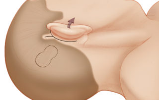 The placement of the cochlear implant receiver/ stimulator (dotted line) should be planned to allow sufficient room between the pinna and the headpiece to enable the comfortable use of a behind-the-ear processor. Approximately 3 to 4 cm should be left between the ear canal and the anterior edge of the device. The device is angled up at about a 45-degree angle superior to the linea temporalis A modified post-auricular incision is used most commonly. Instead of continuing superior to the pinna, the incision can extend into the supra-auricular hairline to facilitate later drilling of the bony well for the receiver/ stimulator case. The length of this extension depends on surgeon preference and the benefit that additional exposure provides when securing the receiver/ stimulator to bone. Sufficient space (at least 1.5 cm) between the incision and the implant should be allowed to minimize the chance of device extrusion through the incision. Minimal shaving of hair is required if drapes are secured sufficiently to adjacent skin.