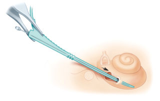The Contour electrode array (Cochlear Corp., Englewood, CO) is also pre-curved, and is mounted on a stylet. (A) In this system, the array and stylet are placed into the cochleostomy together to an optimal depth (as indicated by a white mark on the array). At depths beyond this mark, coiling of the array becomes desirable to follow the natural curvature of the inner ear.