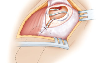 The electrode lead is coiled in the mastoid cavity, with its redundant length gently placed under the bony overhang. Soft tissue is closed over the receiver/stimulator to assist in preventing postoperative migration. The anteriorly based periosteal flap is closed over the mastoid cavity, providing additional separation between the device and the skin incision. The skin is then closed and a mastoid pressure dressing is applied.