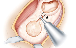 A mastoidectomy is then performed. Unlike the conventional technique for chronic otitis media, the surrounding cortex is not “saucerized”. Instead, bony overhangs are left posteriorly, inferiorly, and superiorly for later use to anchor the electrode lead. A facial recess approach is performed (as described elsewhere) to adequately expose the round window niche and promontory. The incudal buttress is left in place. A well is drilled to accept the electronics casing snugly. Device-specific templates are used to ensure the correct location and depth of this well. In children and others with thin cortical bone, dura may be exposed with a diamond bur. The circumferential exposure of dura at the periphery of the well can leave a mobile “bone island” that can be medially displaced to enable placement of the full depth of the device. A trough (dashed line) is then drilled from the well to the mastoid cavity to accept the electrode lead. Again, bony overhangs help to secure the lead within the trough.