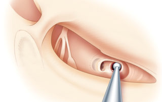 The cochleostomy is then opened with a small diamond bur. The bone of the round window niche can be drilled superiorly to expose the anterior margin of the round window membrane, which is can be a valuable landmark. The cochleostomy is performed just anterior and inferior to the round window. Such positioning of the cochleostomy minimizes trauma to the “hook region” of the basilar membrane.