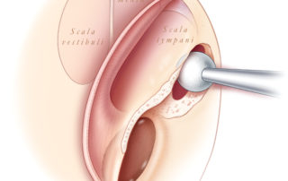 This illustration depicts the creation of a cochleostomy in a right ear in the surgical position. The cochleostomy enters the inferior aspect of the scala tympani. This minimizes cochlear injury by avoiding both the basilar membrane as well as the spiral ligament. The trajectory of drilling must be aimed somewhat superiorly to enter the scala tympani and avoid drilling tangentially past the inferior aspect of the basal turn. (SV, scala vestbuli; SM, scala media; ST, scala tympani; BM, basilar membrane; SL, spiral ligament.)