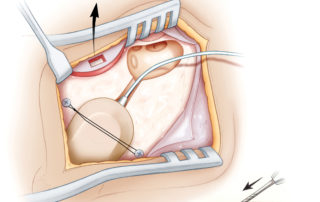 A segment of muscle and fascia is harvested for later use to seal the cochleostomy. This can be harvested superiorly to preserve the inferior free edge of the fascia for use during closure. The implant is placed within the previously created pocket, with the electronics case in the bony well. The surgeon may elect to secure the receiver/ stimulator in place with non-absorbable sutures tied across the case. The sutures can be secured to bone with small (3 or 4 mm) screws placed in the bone (A), or by threading them through obliquely drilled holes in the cortex (B). The use of self-drilling screws can enable bony fixation with sutures even with minimal access incisions. The knot should be kept off of the lateral surface of the receiver/stimulator to minimize the risk of future extrusion of suture material.