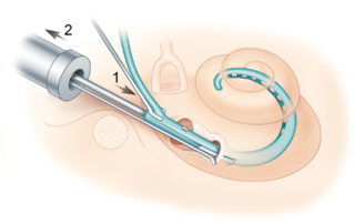 After the Helix coiled array into the scala tympani, the array is stabilized by a small suction tip or micro claw instrument (1), and the insertion instrument and stylet are gently withdrawn (2), leaving the array in place.