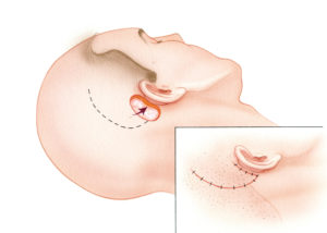 There are numerous reconstructive options for the repair of small defects in the region of the temporal bone. These include local flaps which borrow skin from either the scalp, upper neck, or face. The simplest solution for a limited postauricular defect is a scalp rotation flap as shown here.