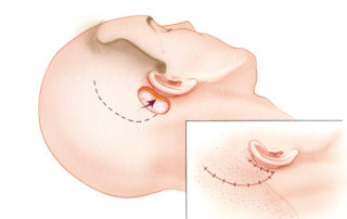 There are numerous reconstructive options for the repair of small defects in the region of the temporal bone. These include local flaps which borrow skin from either the scalp, upper neck, or face. The simplest solution for a limited postauricular defect is a scalp rotation flap as shown here.