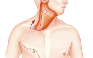 The pectoralis major myocutaneous flap is particularly well suited for resections which are accompanied by radical neck dissection in which its pedicle can be used to cover the carotid artery. Use of this flap on temporal defects is at the far end of its range. This means that it must be designed carefully to afford sufficient length for a tension free placement. When harvested with a skin paddle, the lower portion may have a random blood supply.