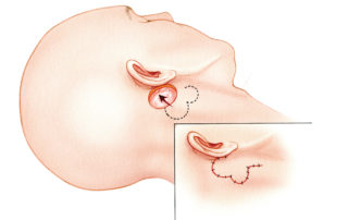 Skin for closure of post-auricular defects can also be borrowed form the upper neck. A bilobed flap can be designed to utilize the cutaneous laxity in the neck without leaving a highly visible scar. As a rule of thumb, the first lobe of the flap should be approximately 75% of the diameter of the defect. The second lobe should be around 50% of its span.