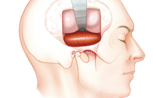 A temporalis muscle flap can also be used to reconstruct defects in the floor of the middle cranial fossa (see Chapter 16). In this use, the upper fan shaped portion of the muscle is rotated inward underneath the temporal lobe. To retain the option of using this flap during a middle fossa craniotomy, it is important to use an incision (such as the inferiorly based U-shaped flap) which preserves the blood supply to this muscle. (see section 5.1 in Chapter 5). When a linear pre-auricular incision is used for middle fossa craniotomy, the temporalis muscle is usually transected at the level of the zygomatic arch, making it unavailable for use as a reconstructive flap.