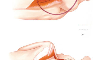 The trapezius myocutaneous flap is the workhorse for posterolateral cranial base reconstruction. Based upon the transverse cervical artery it rotates well into temporal defects with a minimal donor deficit. The trapezius myocutaneous flap can include a skin paddle to replace a cutaneous defect, as shown here. When the muscle layer alone is used, it may serve to close the cerebrospinal fluid space and/or to help restore contour defects after extensive cranial base resection.