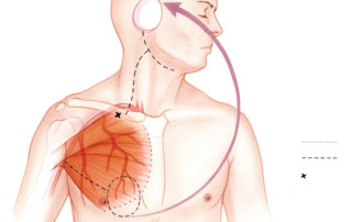 The pectoralis major myocutaneous flap, based upon the the thoracoacromial artery, may also be used for the reconstruction of temporal skull base defects.