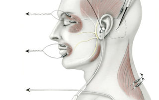 The cranial nerve monitoring montage utilized during surgery of the cerebellopontine angle includes electrodes placed in the muscles innervated by each motor nerve in the region (cranial nerves 5, 7, and 11). To monitor the facial nerve, electrode pairs are inserted into both the orbicularis oris and oculi muscles. The motor division of the trigeminal is monitored through an electrode pair in the temporalis muscle.