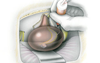 Using a stimulating probe with a flexible tip permits (Yingling probe®, Medtronic Inc., Jacksonville, FL) stimulation of portions of the tumor capsule not directly in the surgeon’s line of sight. Early identification of the facial nerve “around the corner” on the ventral surface of the tumor helps to speed the procedure by permitting rapid removal of the remaining capsule. (7, facial nerve; 8, audiovestibular nerve; 5, trigeminal nerve.)