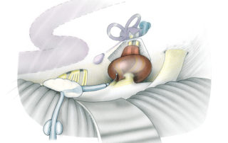 The disadvantage of auditory brainstem responses in the assessment of cochlear nerve function is the several minute delay inherent in the averaging process. Placement of a recording electrode directly upon the proximal eighth nerve provides immediate and continuous information concerning the status of the auditory system.